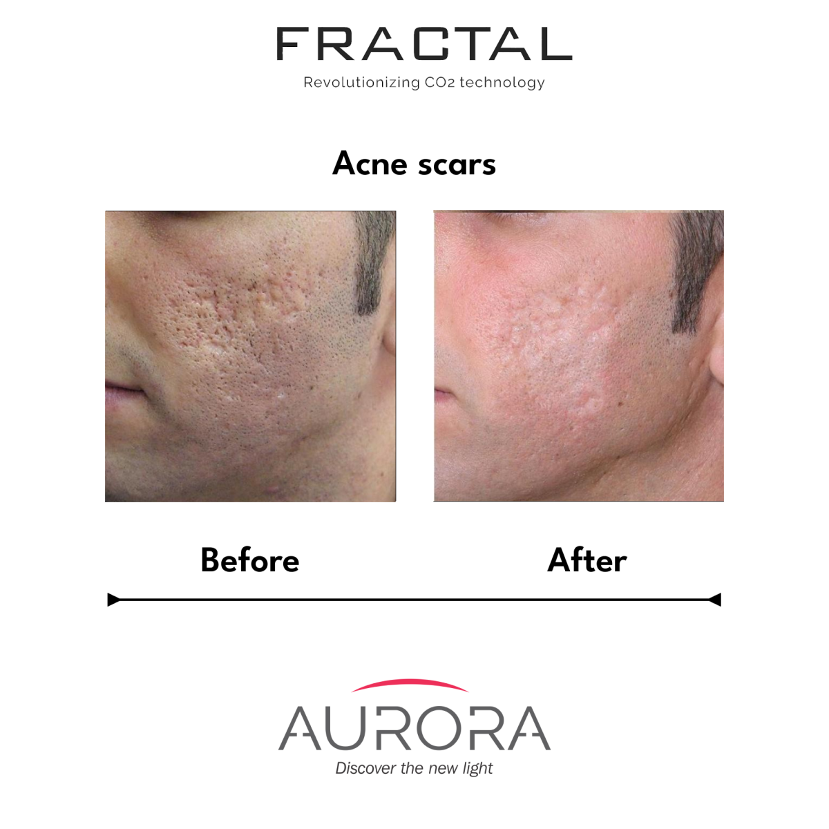 acne scars fractal