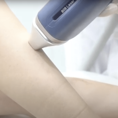 The future of hair removal: 4-wave diode laser technology