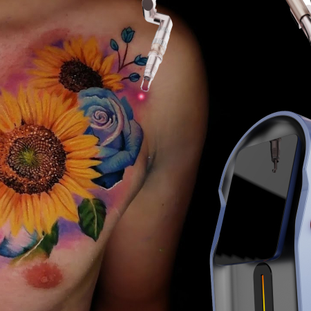 Color tattoo removal with Prisma