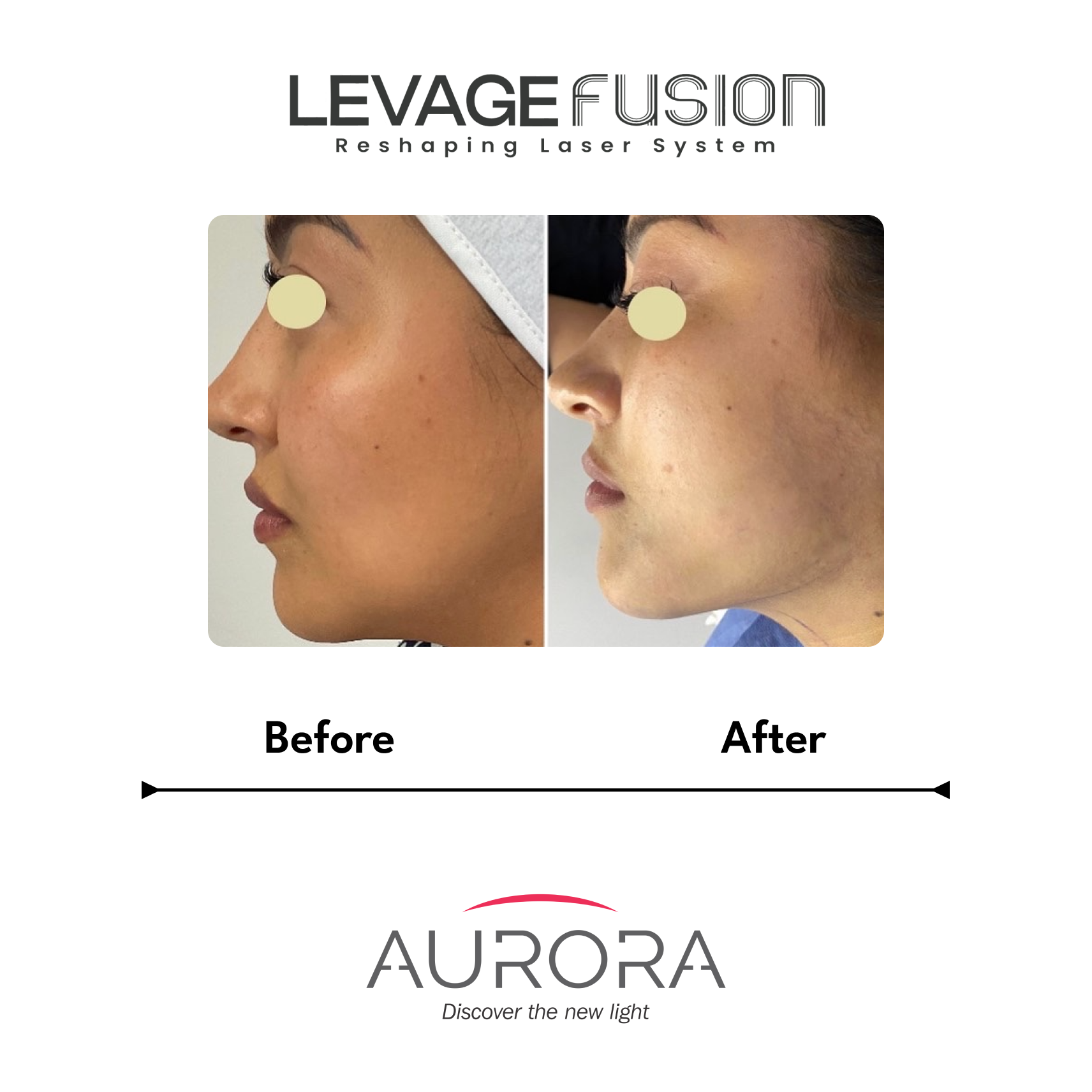 levage fusion before-after