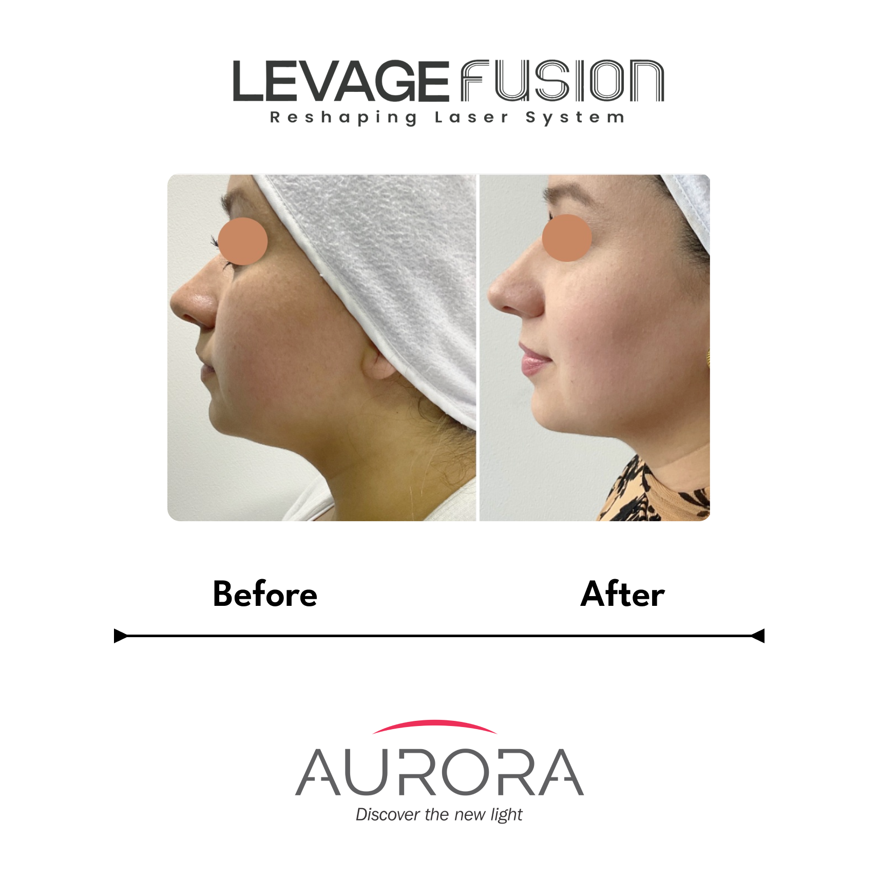 levage fusion before-after