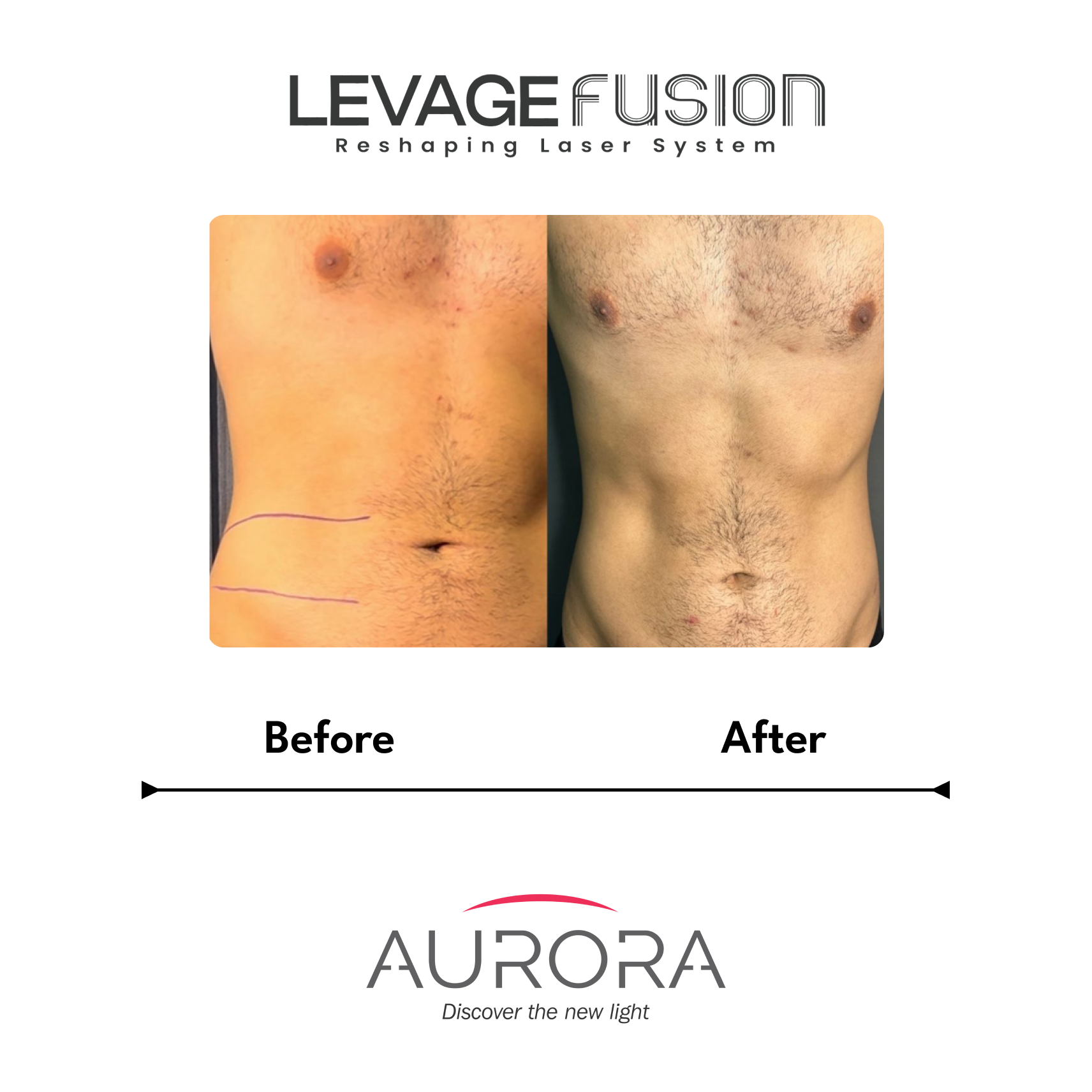 levage fusion before-after