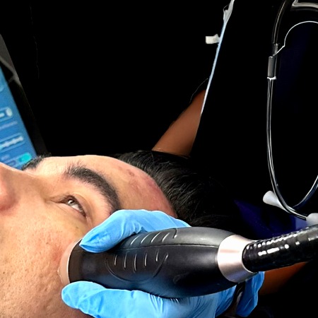 5 Myths and Realities About RF Microneedling