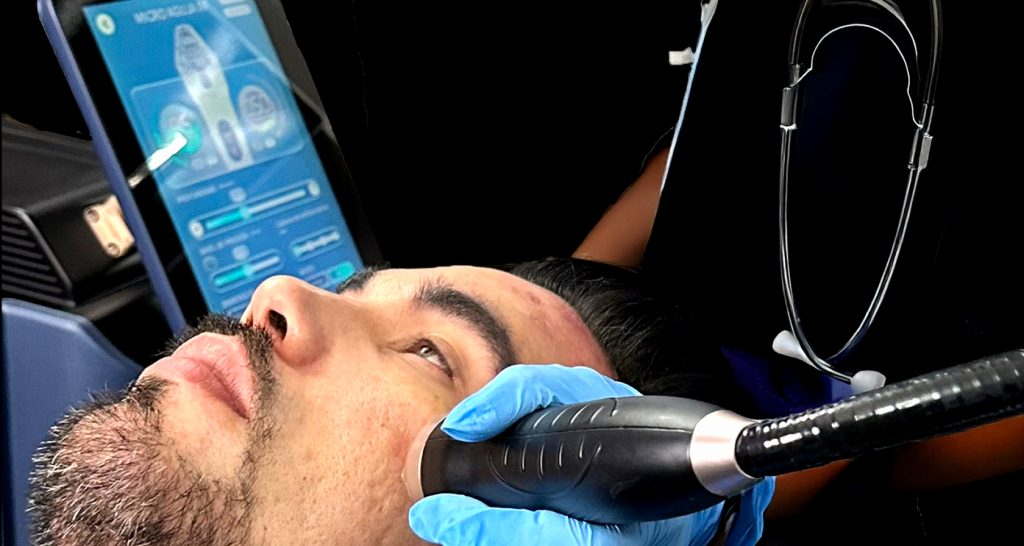 RF Microneedling