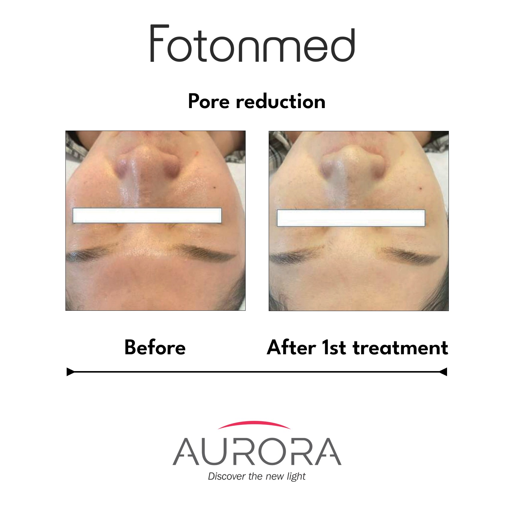 pore reduction