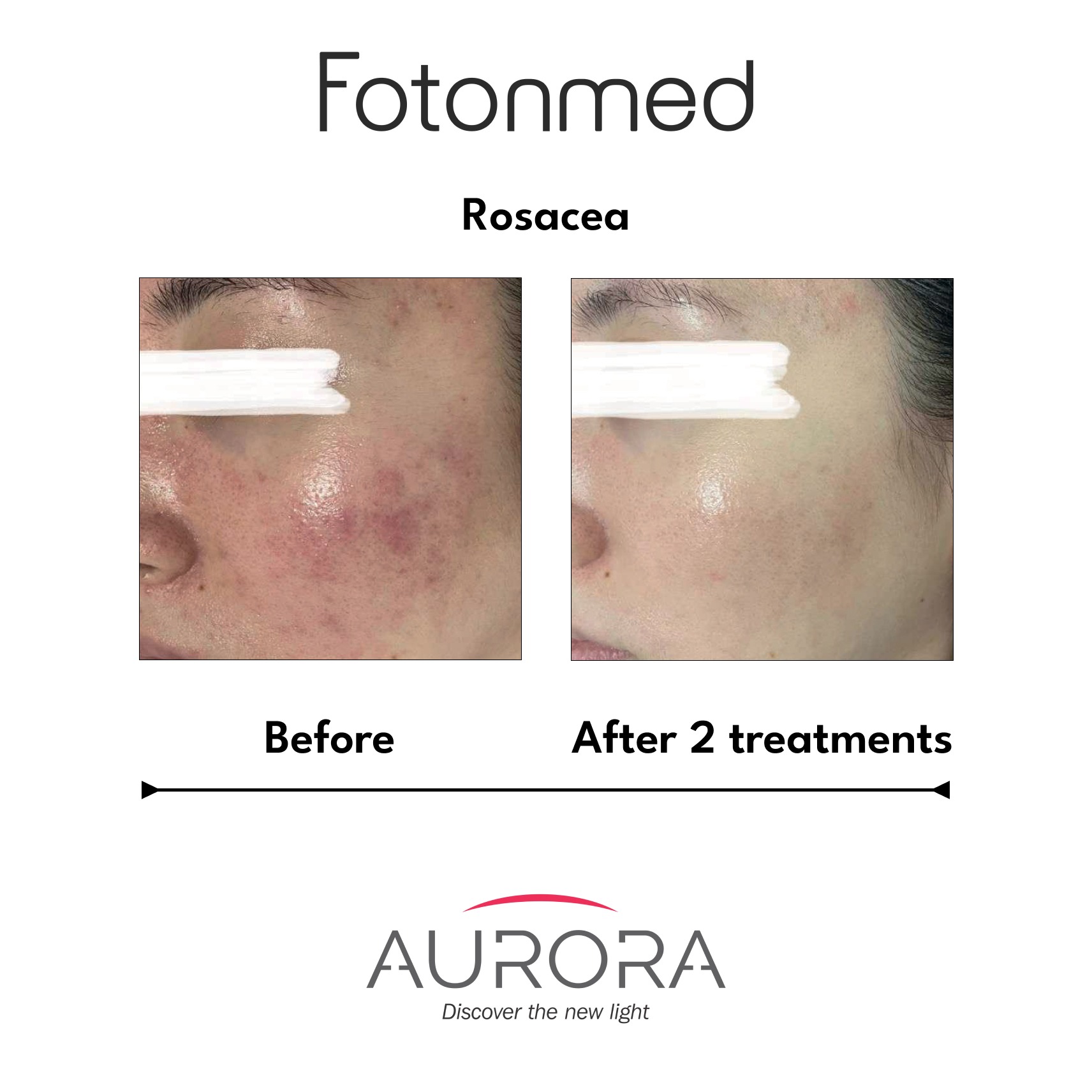 rosacea